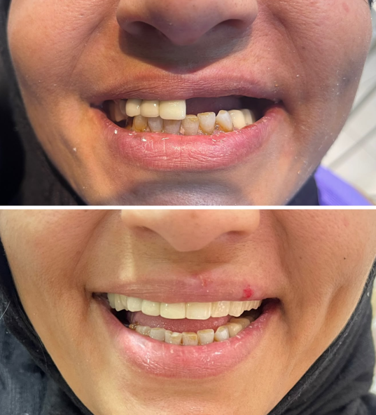 تعويض الأسنان الأمامية